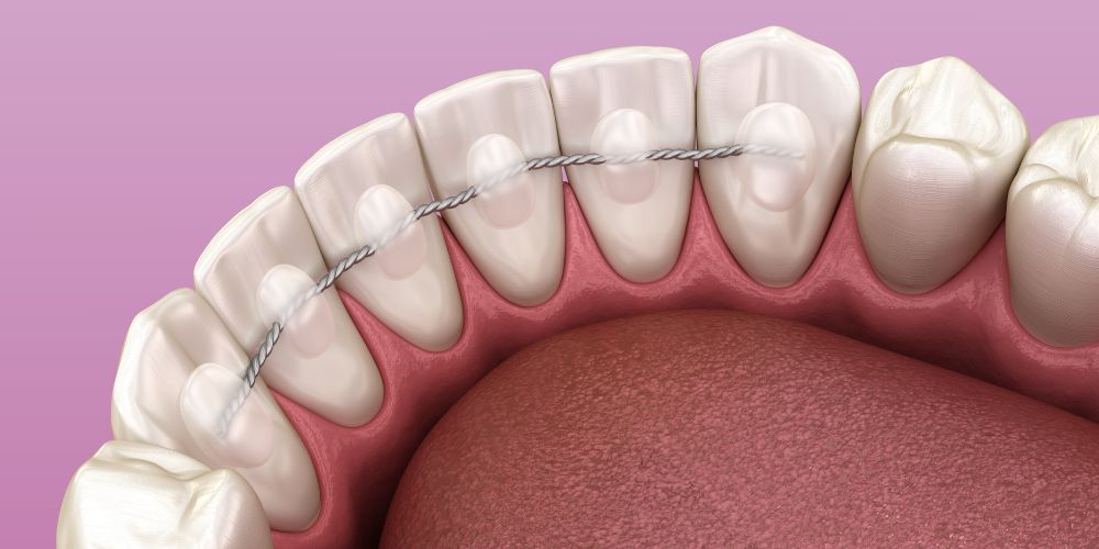 Contention orthodontique paris10